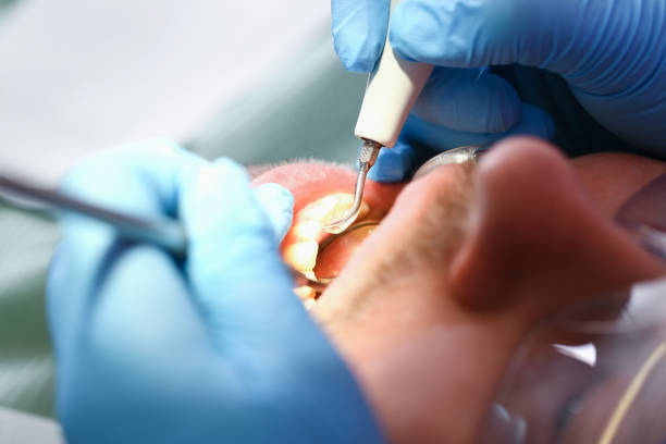 Best Emergency Dentist for Lost Fillings or Crowns in Herculaneum, MO